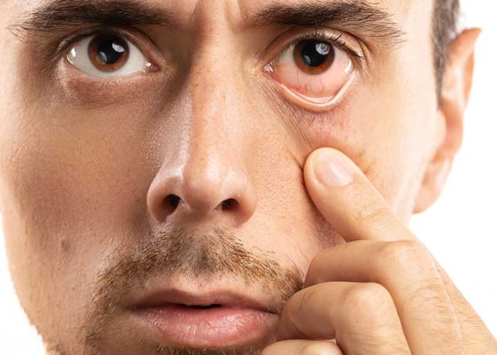 Como diferenciar Alergia nos olhos da Covid 19