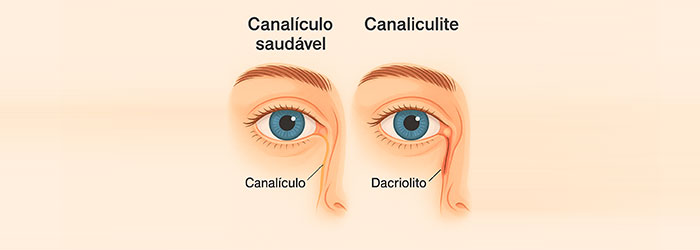 canaliculo saudável vs canaliculite