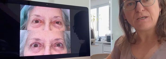 resultado blefaroplastia secundária