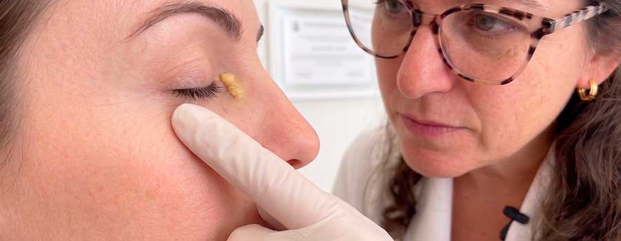oftalmologista avaliando xantelasma